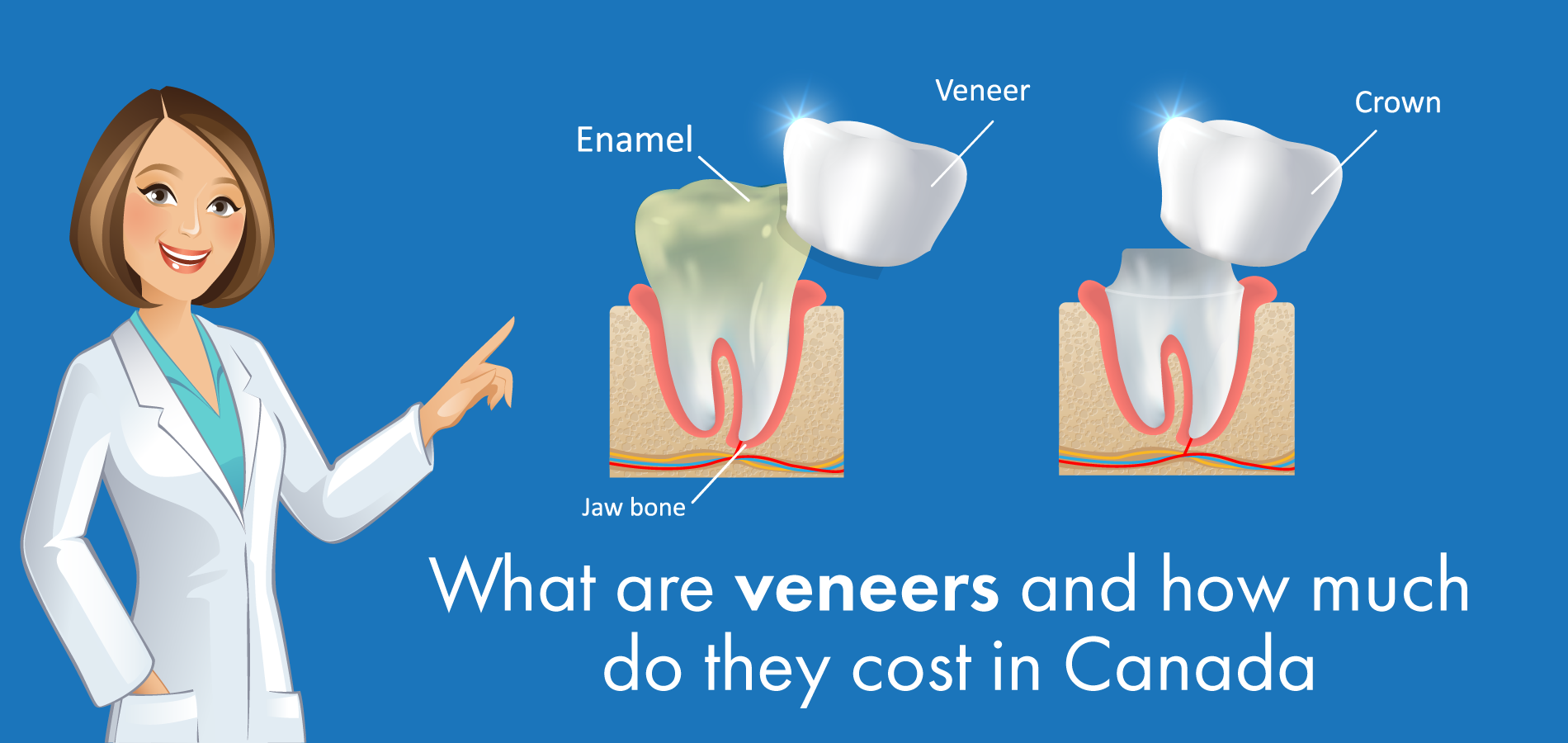 What are veneers and how much do they cost in Canada