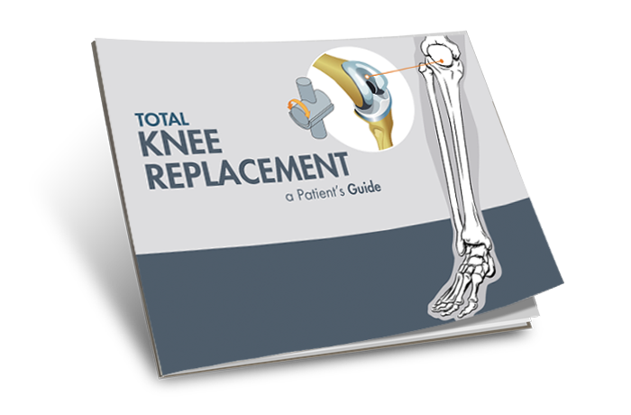 The Guide to Knee Replacement